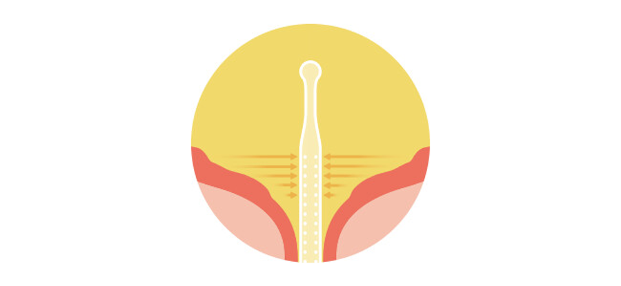 Diagram van een Luja-katheter in de blaas. De Micro-hole Zone Technology van Luja is ontworpen om urine vanuit de bodem van de blaas af te voeren en een ononderbroken, vrije urinestroom mogelijk te maken